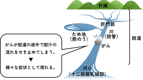 がんが胆道の途中で胆汁の流れをせき止めてしまうことで様々な症状として現れる