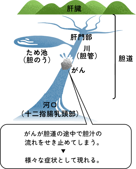 がんが胆道の途中で胆汁の流れをせき止めてしまうことで様々な症状として現れる