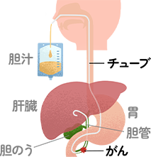 内視鏡的経鼻胆管ドレナージ