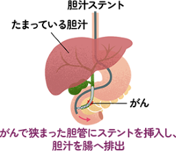 内視鏡的胆管ステント留置術