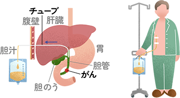 経皮経肝胆道ドレナージ