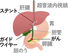 超音波内視鏡下胆道ドレナージ